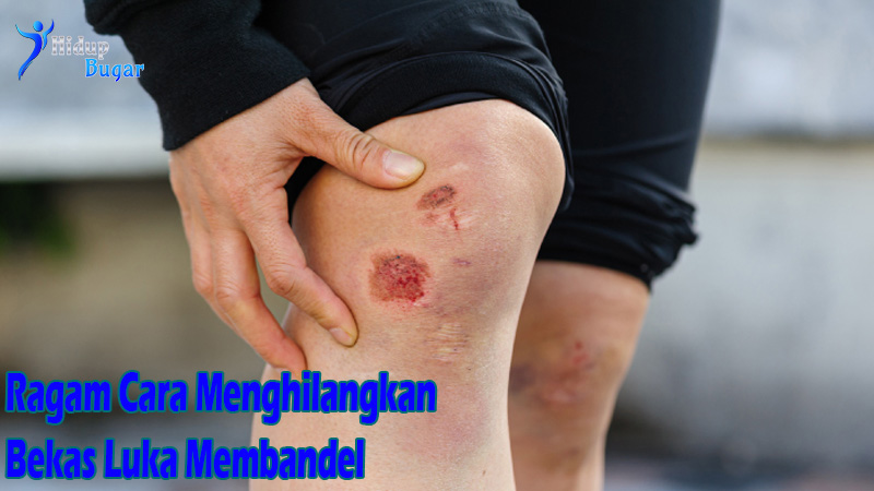Ragam Cara Menghilangkan Bekas Luka Membandel