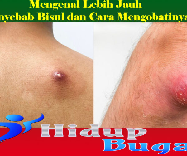 Mengenal Lebih Jauh Penyebab Bisul dan Cara Mengobatinya