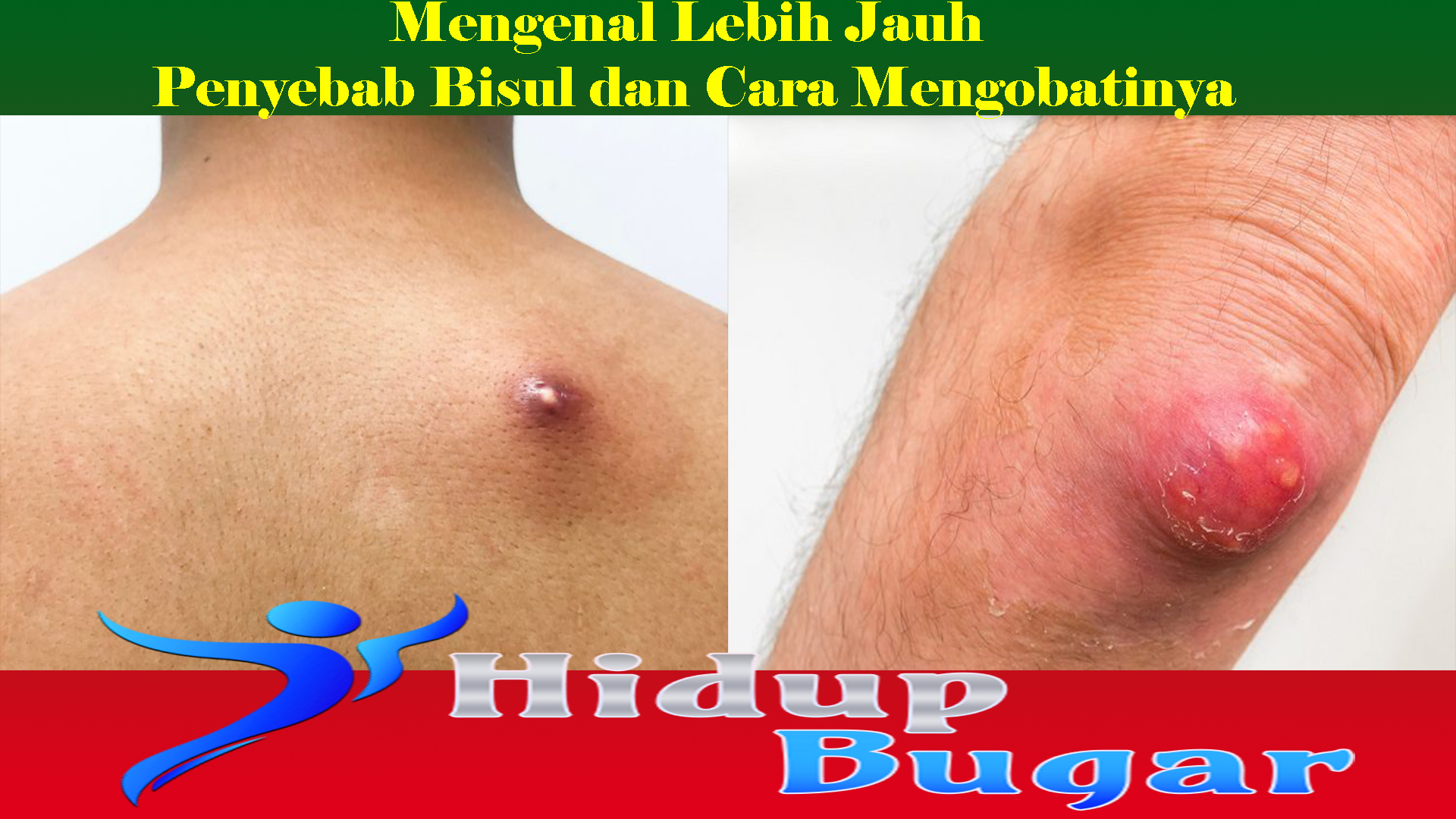 Mengenal Lebih Jauh Penyebab Bisul dan Cara Mengobatinya