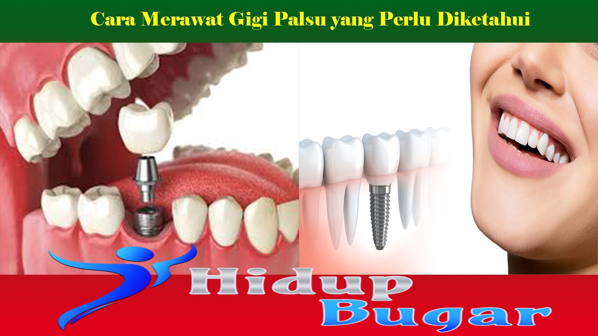 Cara Merawat Gigi Palsu yang Perlu Diketahui