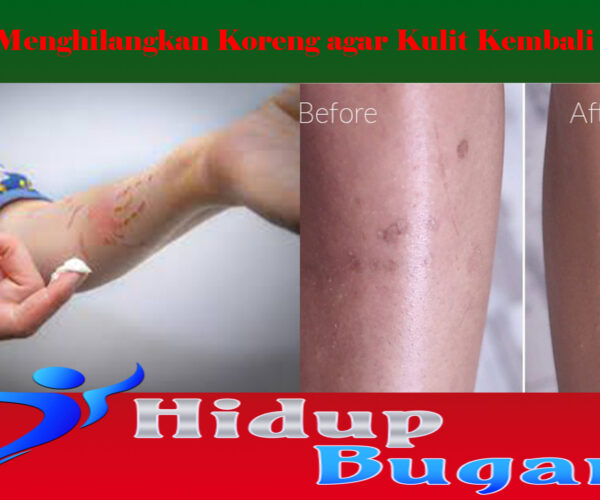 Cara Menghilangkan Koreng agar Kulit Kembali Mulus