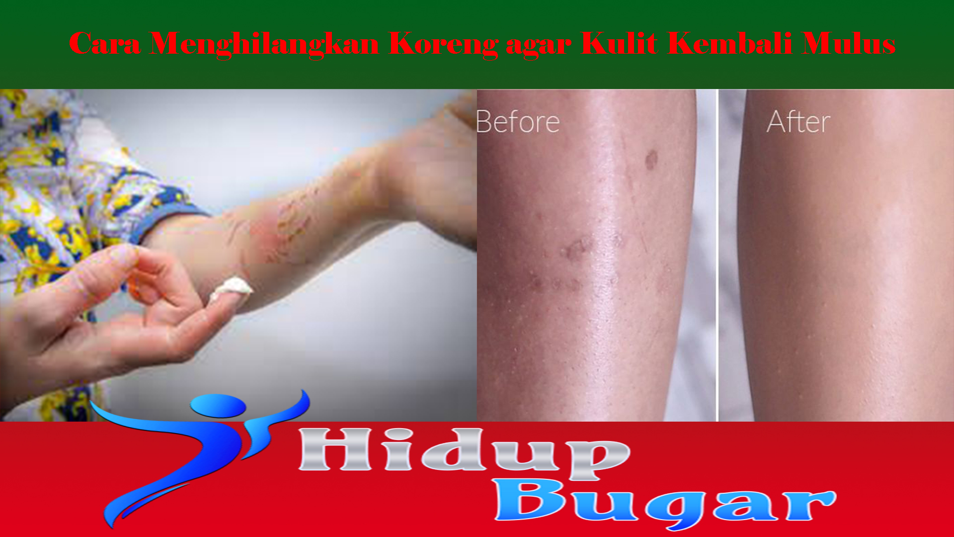 Cara Menghilangkan Koreng agar Kulit Kembali Mulus