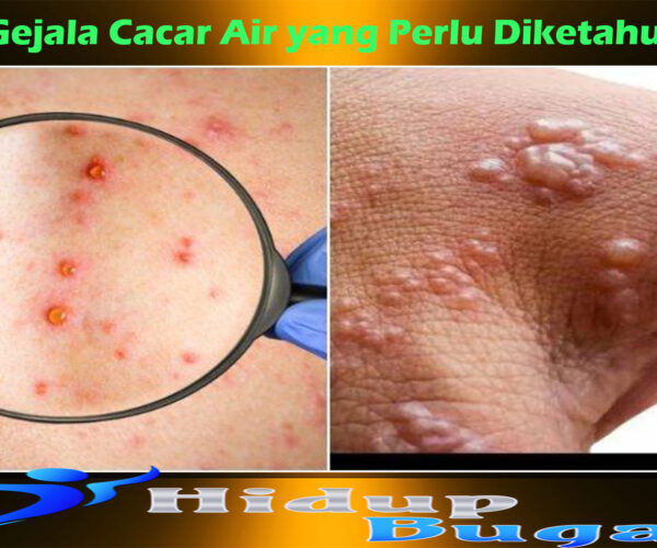 Gejala Cacar Air yang Perlu Diketahui