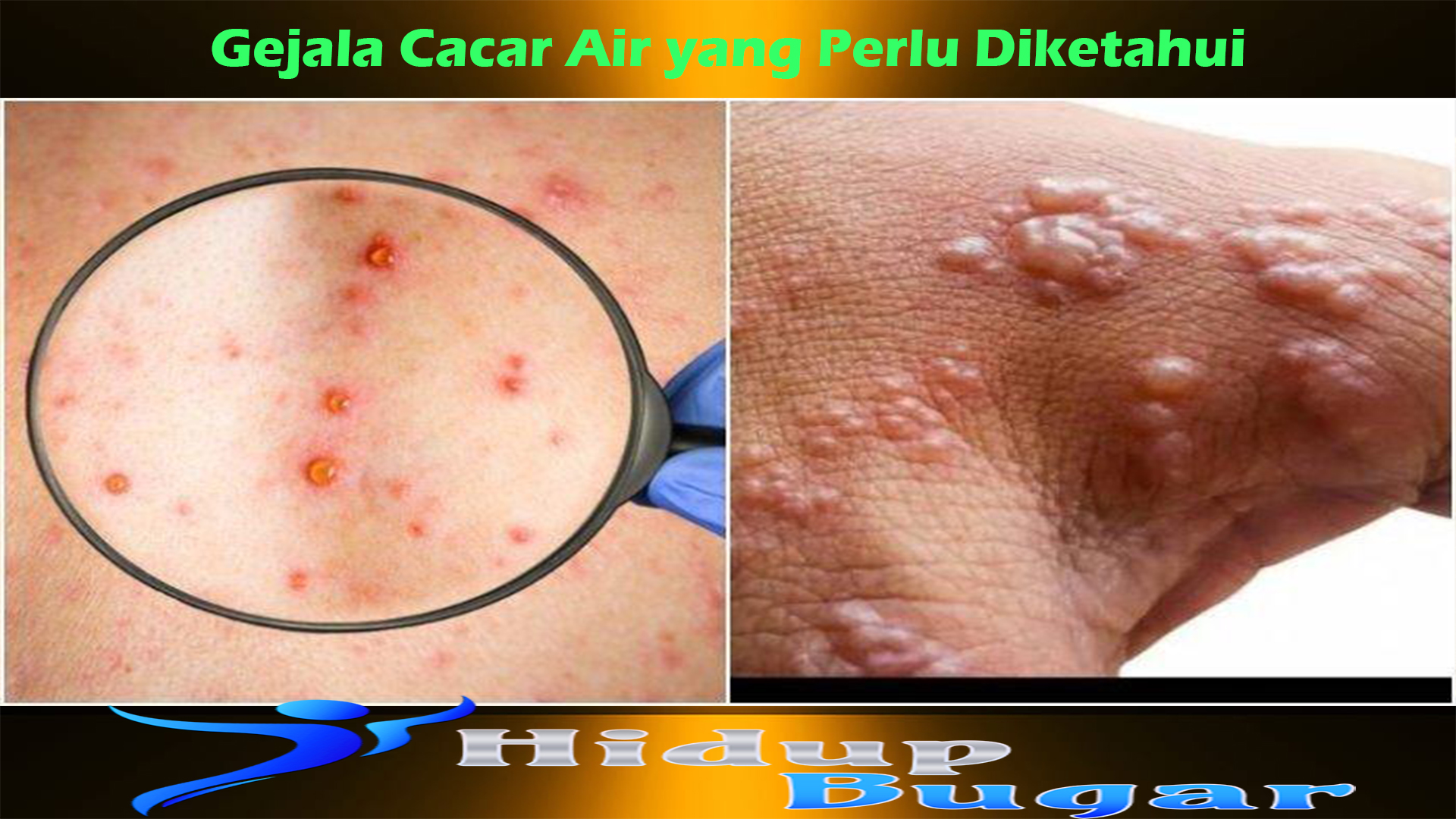 Gejala Cacar Air yang Perlu Diketahui