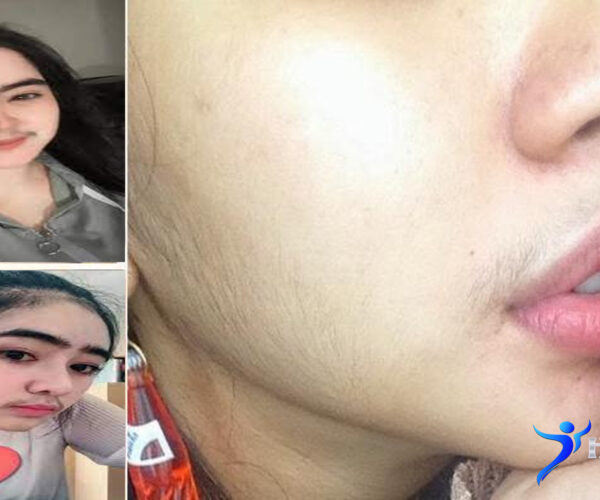 Ini Penyebab Wanita Berkumis dan Cara Mengatasinya